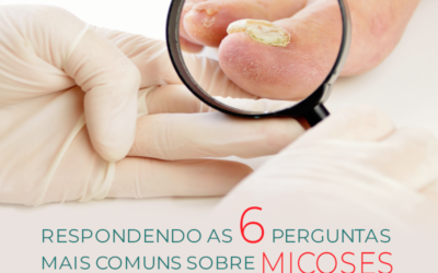 Onicomicose – Perguntas comuns