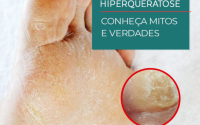 HIPERQUERATOSE – MITOS E VERDADES