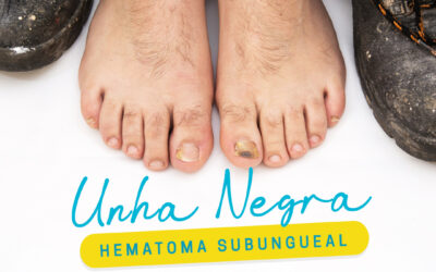 UNHA NEGRA – HEMATOMA